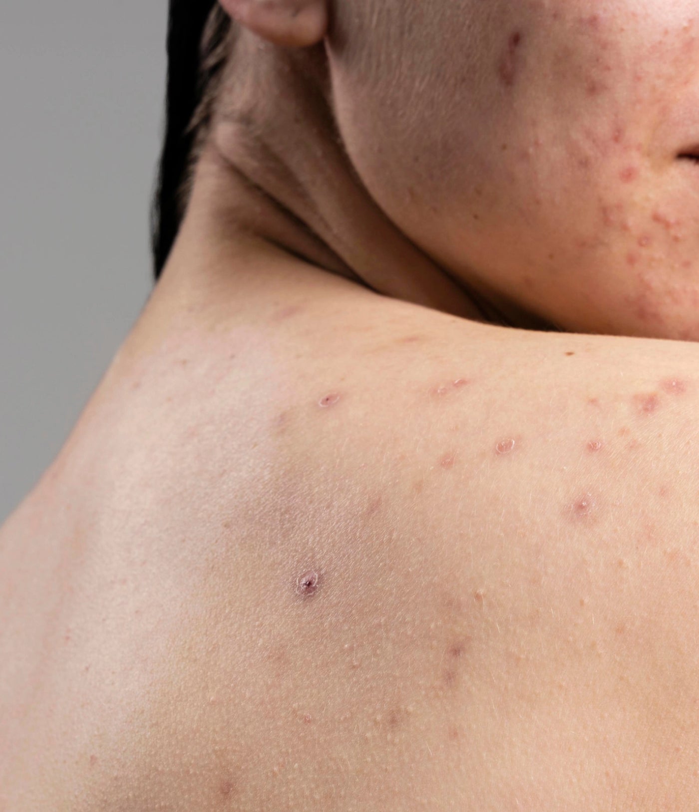 Rélavie Skin Care Products - Natural Ingredients - Acne